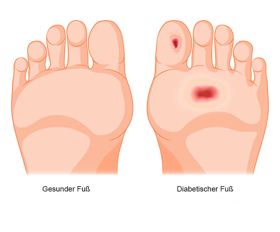 Diabetischer Fuß